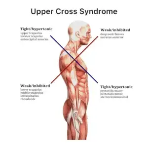 Diagram illustrating Upper Cross Syndrome, showing muscle imbalances in the neck, shoulders, and chest caused by poor posture. The image highlights overactive muscles and weakened muscles leading to a rounded shoulder and forward head posture.